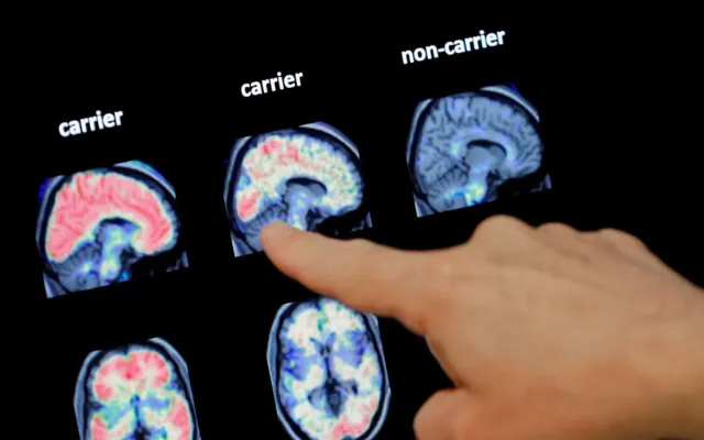 AI dự đoán mất trí nhớ