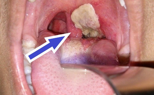 dấu hiệu mắc bệnh bạch hầu