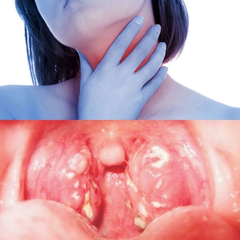 biến chứng bạch hầu