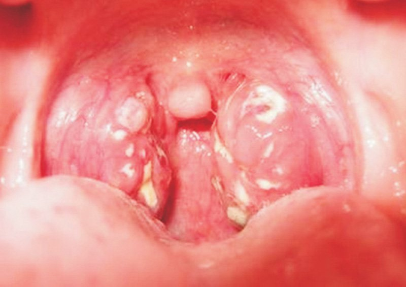thời gian ủ bệnh bạch hầu