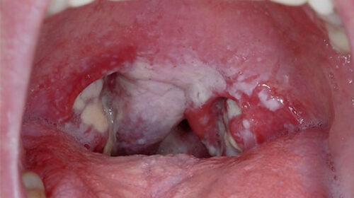 thời gian ủ bệnh bạch hầu