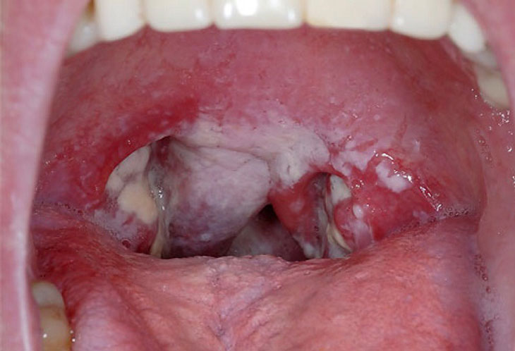 thời gian ủ bệnh bạch hầu
