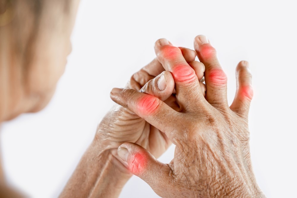 dấu hiệu bệnh gút và cách chữa