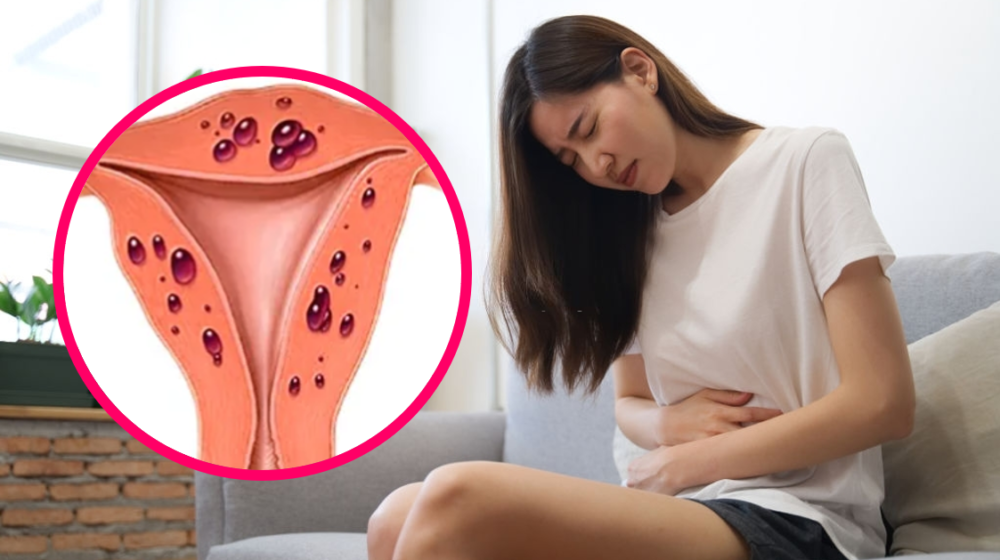 bệnh nội mạc tử cung có nguy cơ ung thư buồng trứng cao