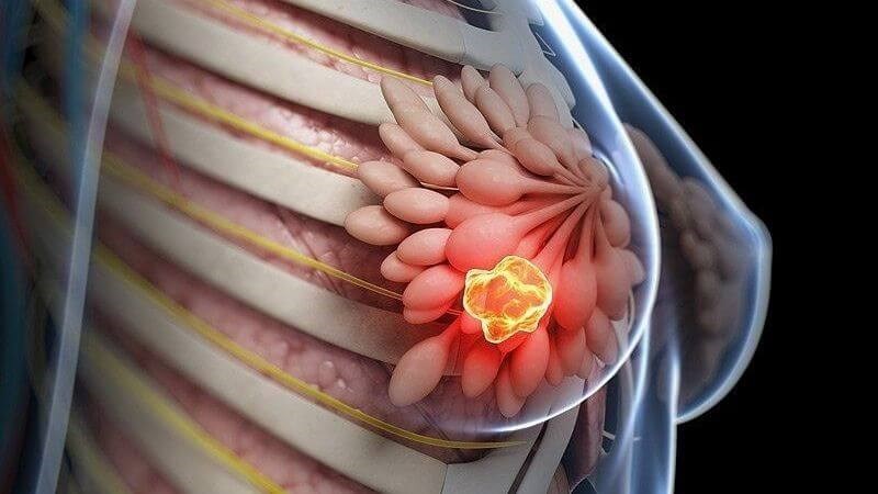 cắt bỏ 2 bên ngực không làm tăng khả năng sống cho bệnh nhân ung thư vú