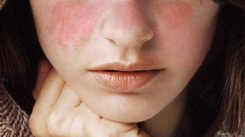 dấu hiệu lupus ban đỏ hệ thống