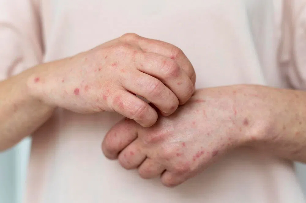 WHO họp khẩn vì biến thể đậu mùa khỉ tăng vọt ca mắc