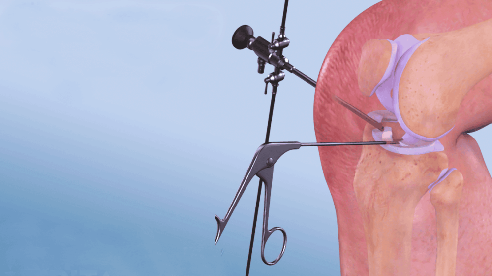 phẫu thuật rách sụn chêm đầu gối