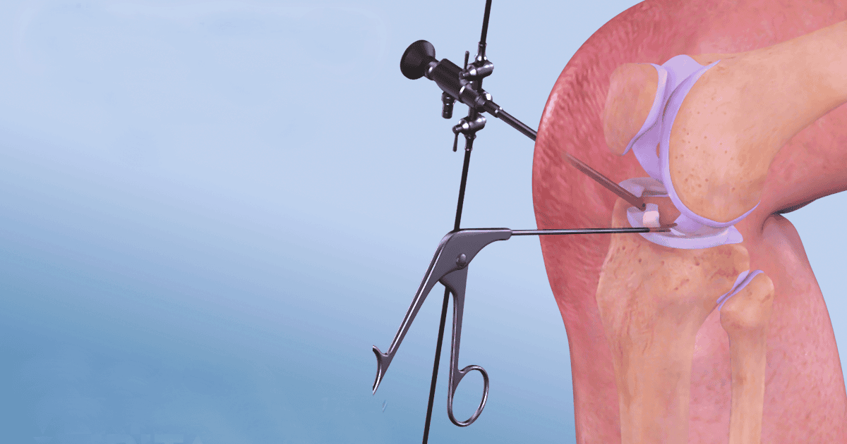 phẫu thuật rách sụn chêm đầu gối