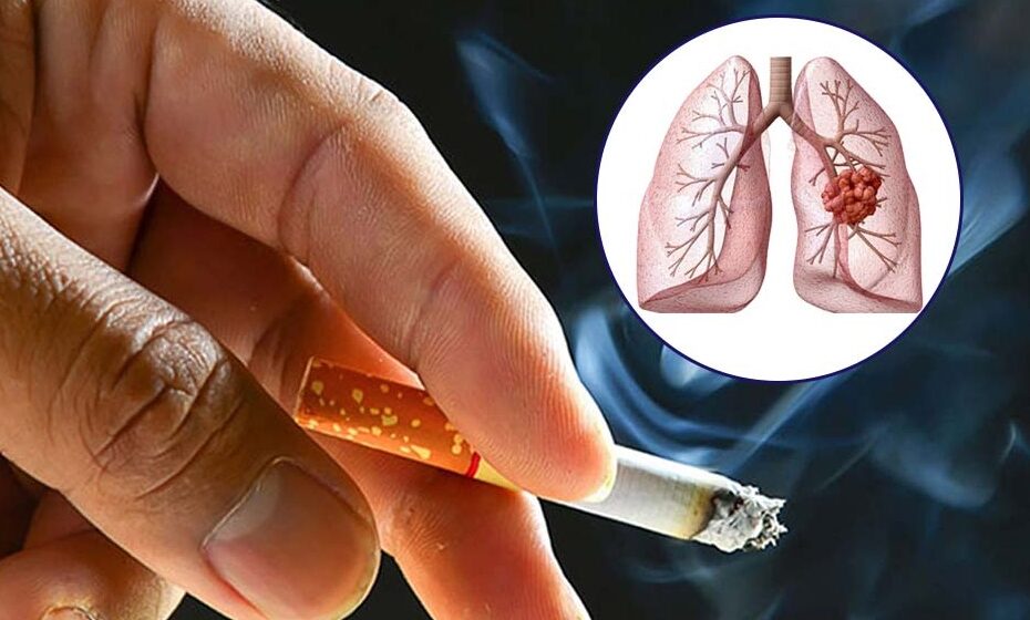 dấu hiệu triệu chứng bệnh ung thư phổi