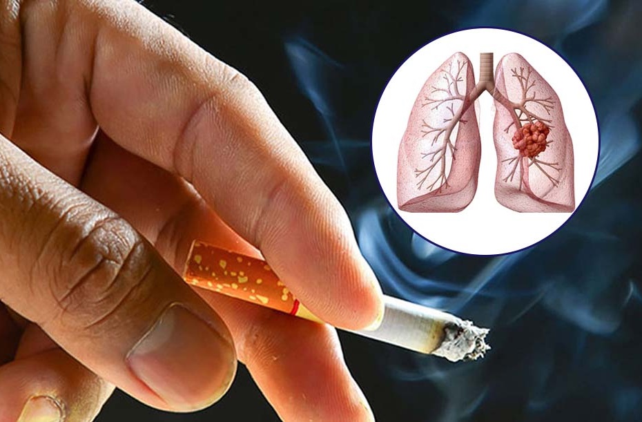 dấu hiệu triệu chứng bệnh ung thư phổi