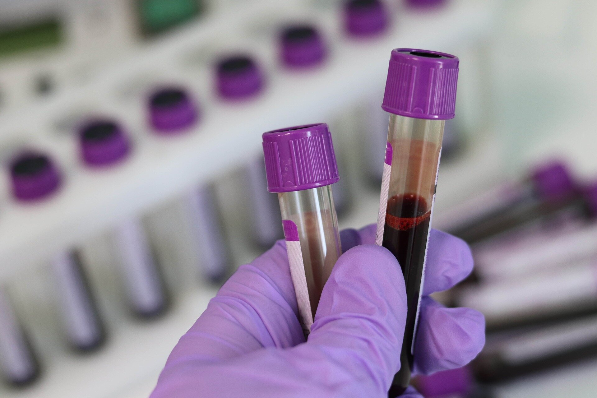 xét nghiệm máu đồng hồ tuổi proteomic phát hiện bệnh