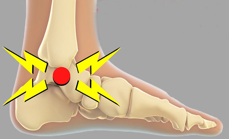 khớp kêu răng rắc hoặc lục cục