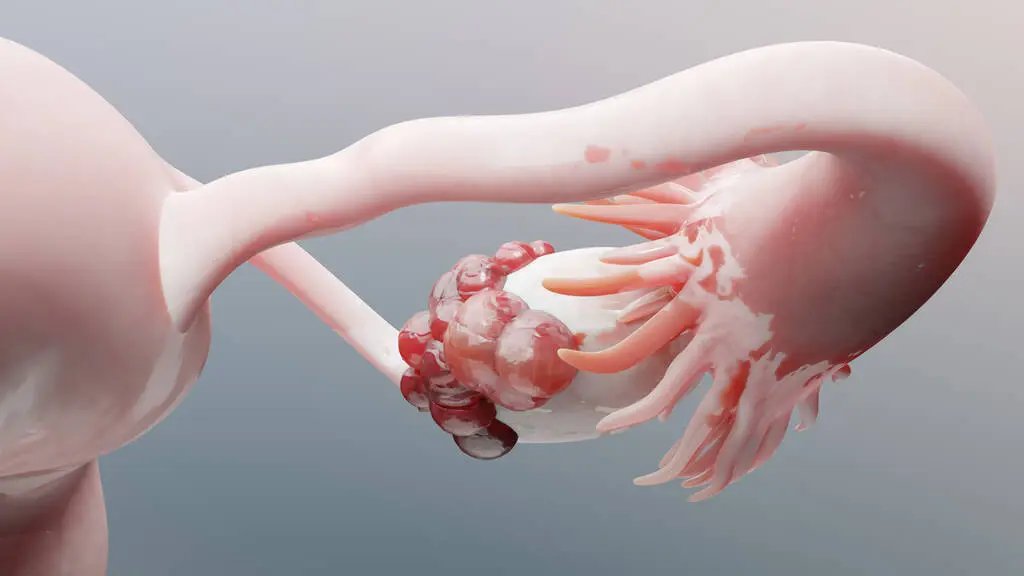 ung thư buồng trứng yduocthainguyen