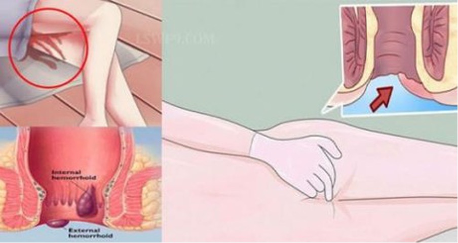 ung thư hậu môn yduocthainguyen.vn