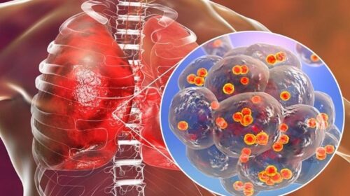viêm trong cơ thể cảnh báo ung thư