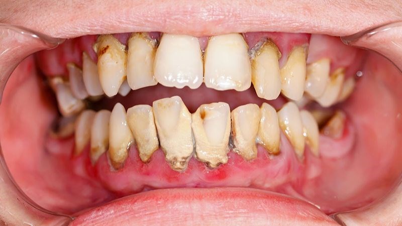 viêm trong cơ thể cảnh báo ung thư