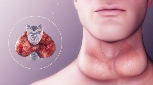 HDL thấp làm tăng nguy cơ tái phát ung thư tuyến giáp thể nhú yduocthainguyen