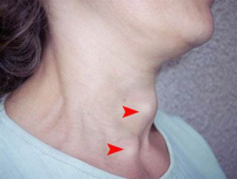 HDL thấp làm tăng nguy cơ tái phát ung thư tuyến giáp thể nhú yduocthainguyen