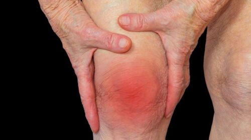 Viêm khớp dạng thấp và bệnh tim mạch yduocthainguyen