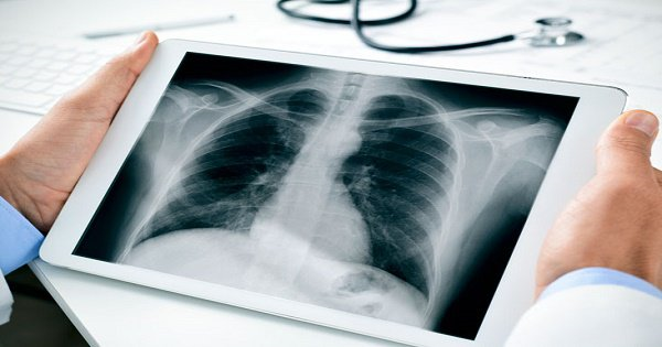 những người dễ bị ung thư tuyến giáp yduocthainguyen