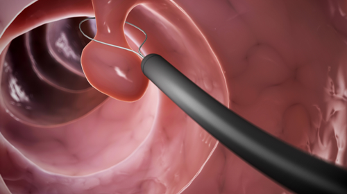polyp cổ tử cung y duoc thai nguyen