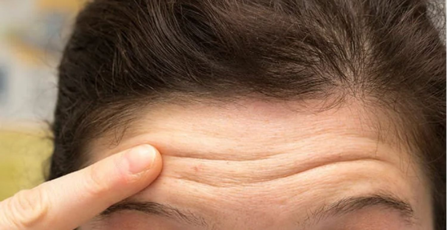 nếp nhăn vùng trán cảnh báo bệnh tim mạch y duoc thai nguyen