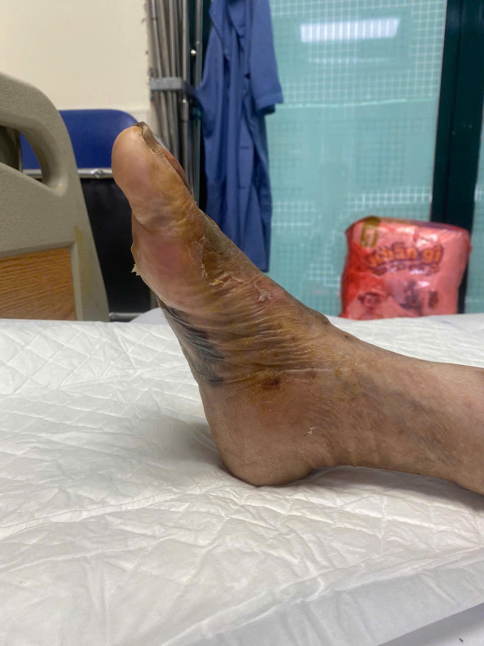 tưởng bệnh xương khớp hóa ra bị viêm tắc tĩnh mạch y duoc thai nguyen