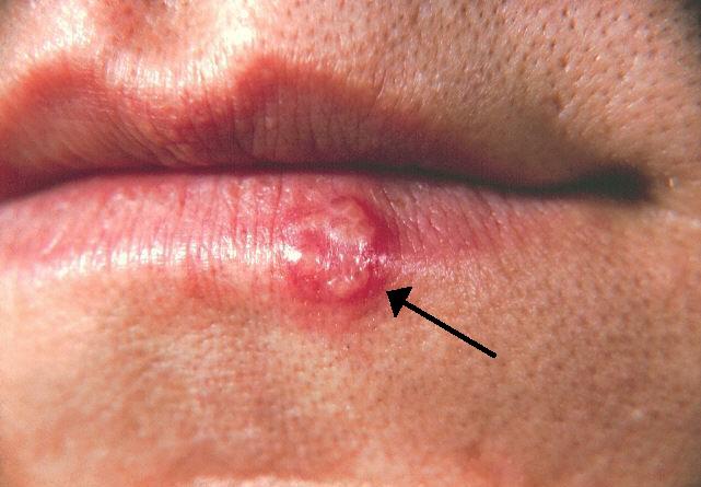 bệnh lây truyền qua đường tình dục làm tăng nguy cơ mất trí nhớ y duoc thai nguyen