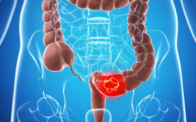 bổ sung đủ vitamin D giúp giảm nguy cơ ung thư đại trực tràng y duoc thai nguyen