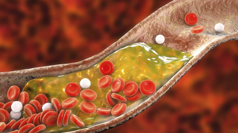 dấu hiệu cholesterol cao y duoc thai nguyen