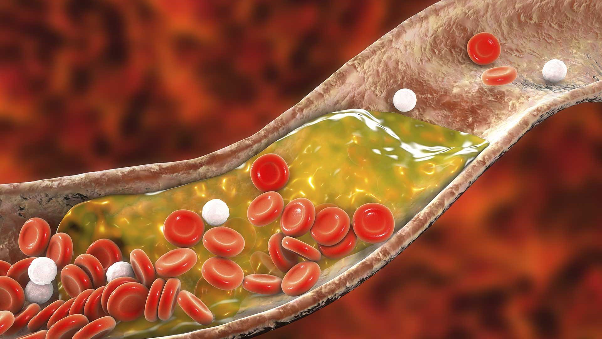 dấu hiệu cholesterol cao y duoc thai nguyen