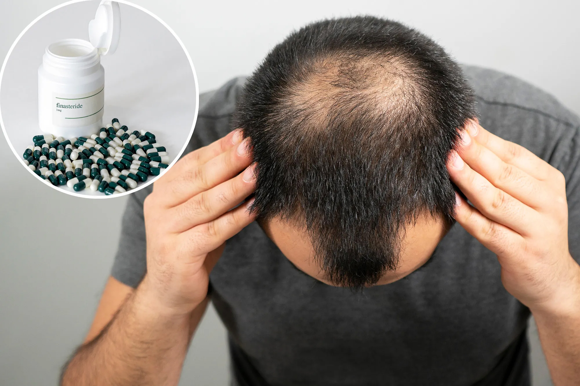 thuốc chống rụng tóc làm tăng nguy cơ rối loạn cương dương y duoc thai nguyen