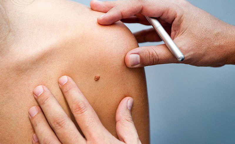 dấu hiệu cảnh báo ung thư da y duoc thai nguyen