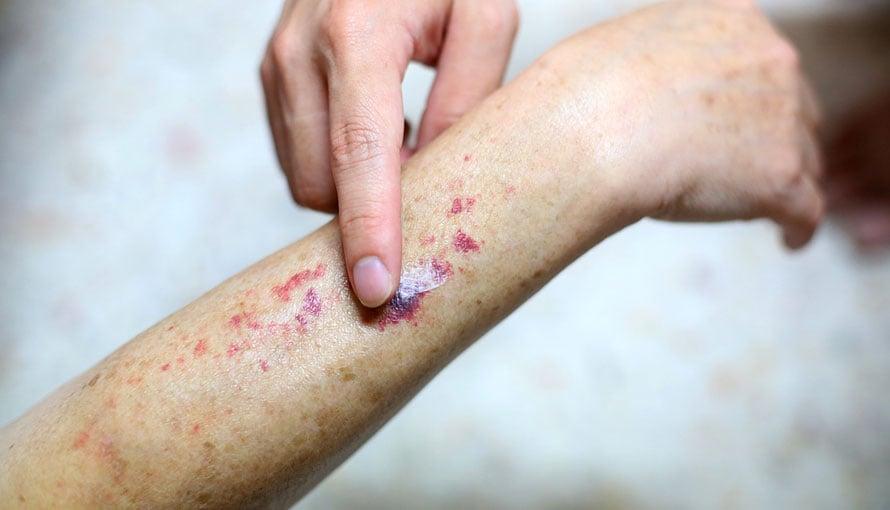 Ung thư máu myeloma y duoc thai nguyen