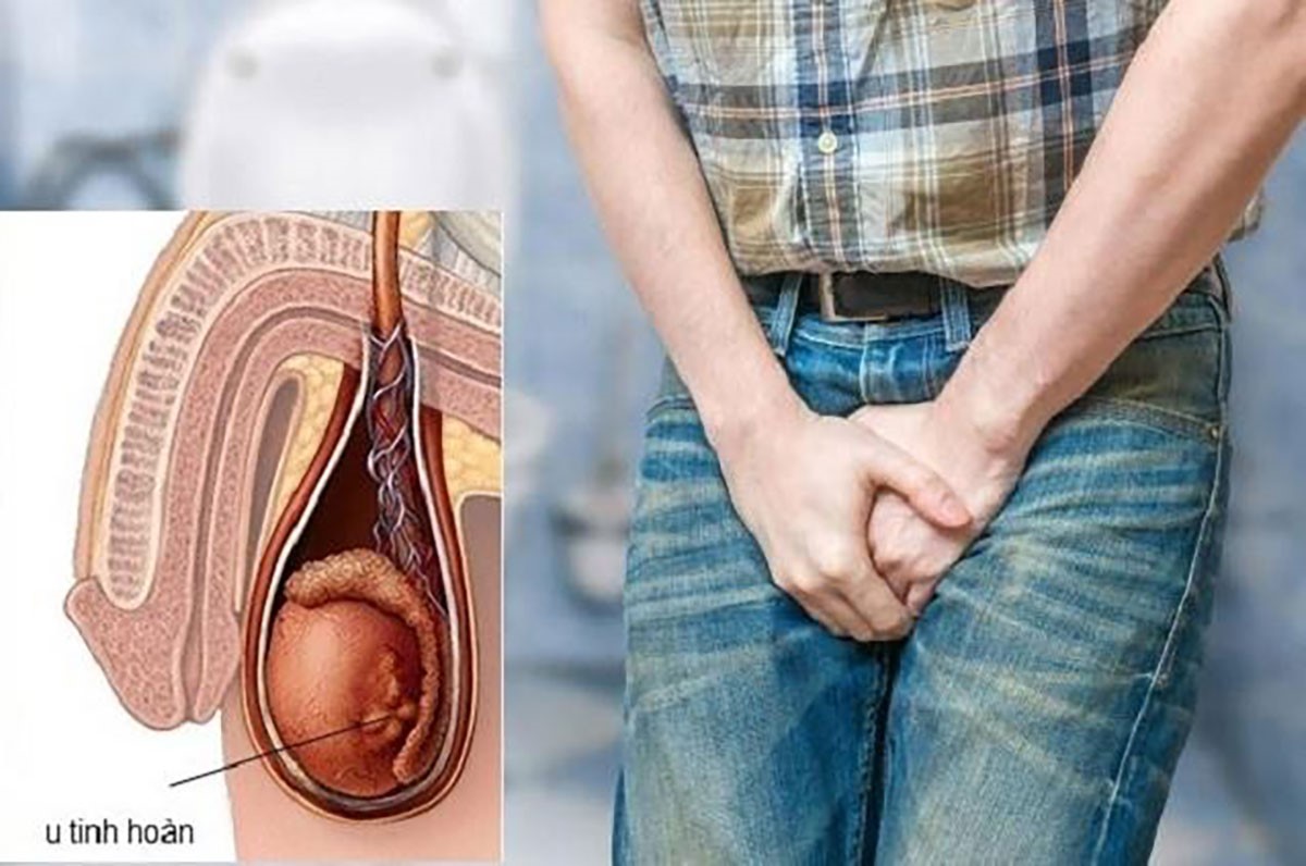 phát hiện ung thư tinh hoàn sau tắm y duoc thai nguyen