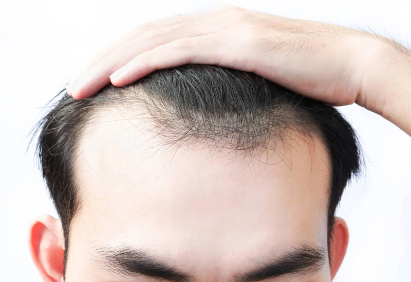trị hói đầu rụng tóc ưu việt dự kiến vào năm 2029 y duoc thai nguyen