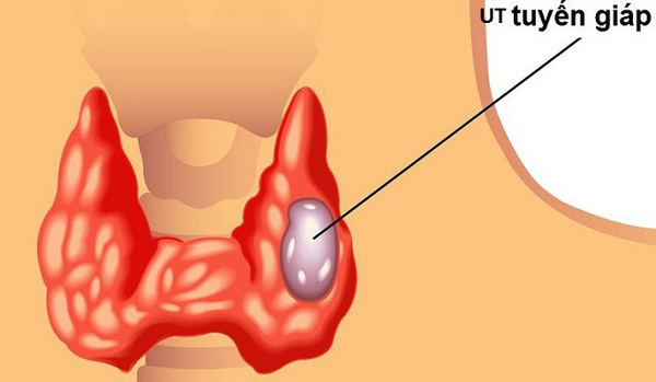 ung thư tuyến giáp gia tăng y duoc thai nguyen