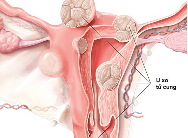 u xơ tử cung y duoc thai nguyen