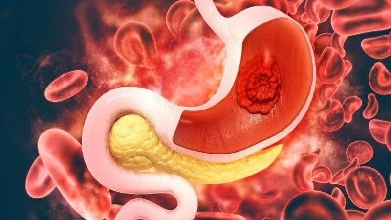 vi khuẩn phổ biến trong nước và thực phẩm gây ung thư dạ dày y duoc thai nguyen