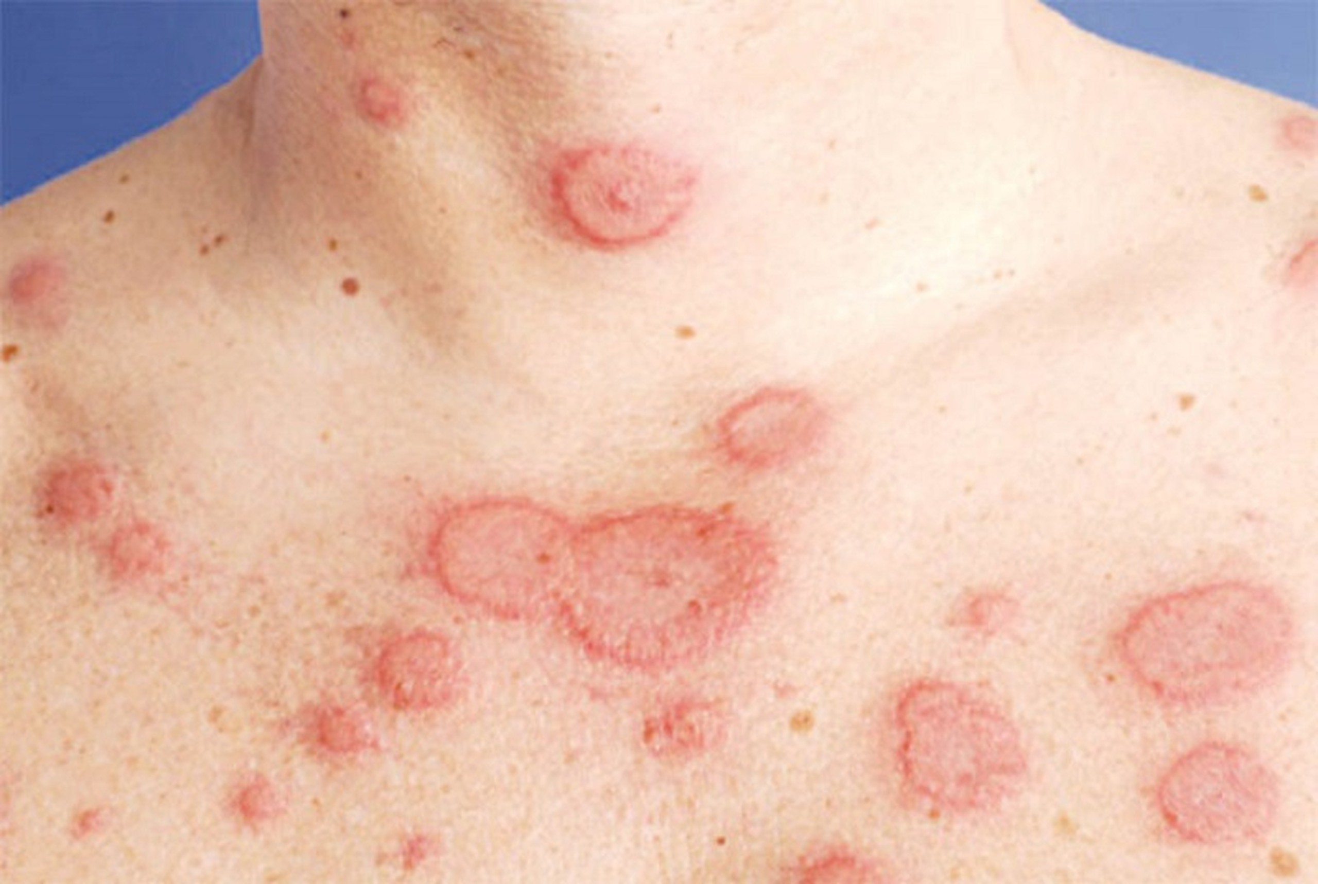 phân biệt viêm khớp và lupus y duoc thai nguyen