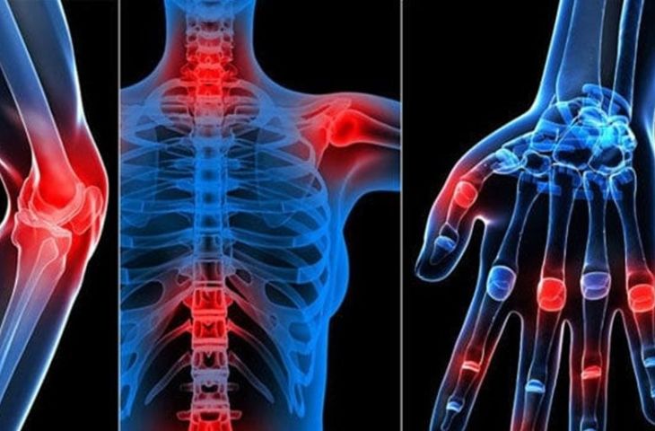 phân biệt viêm khớp và lupus y duoc thai nguyen