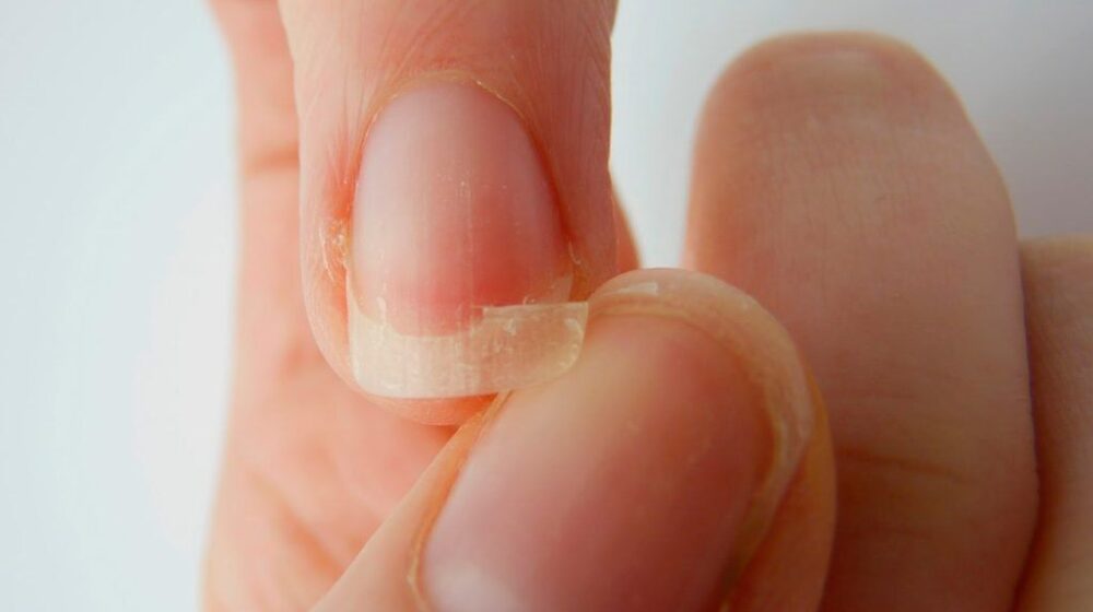 dấu hiệu ở móng tay cảnh báo thiếu kẽm y duoc thai nguyen