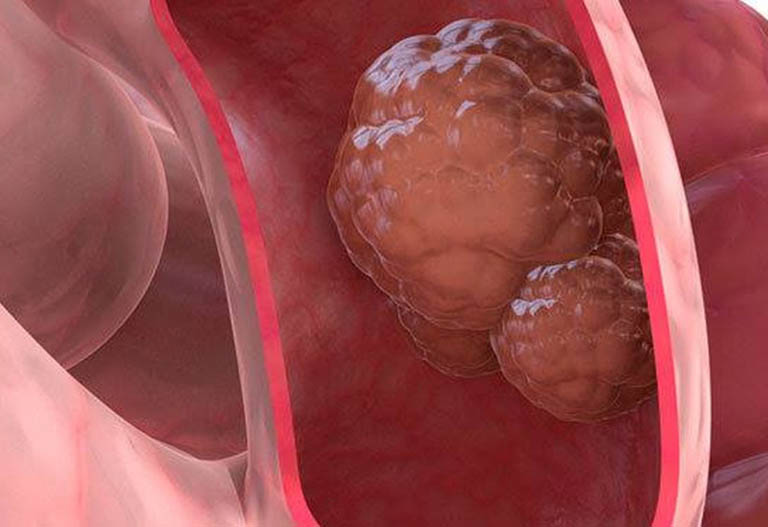 dấu hiệu ung thư đại trực tràng thường bị bỏ qua y duoc thai nguyen