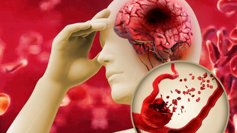 sơ cứu đột quỵ tại nhà y duoc thai nguyen