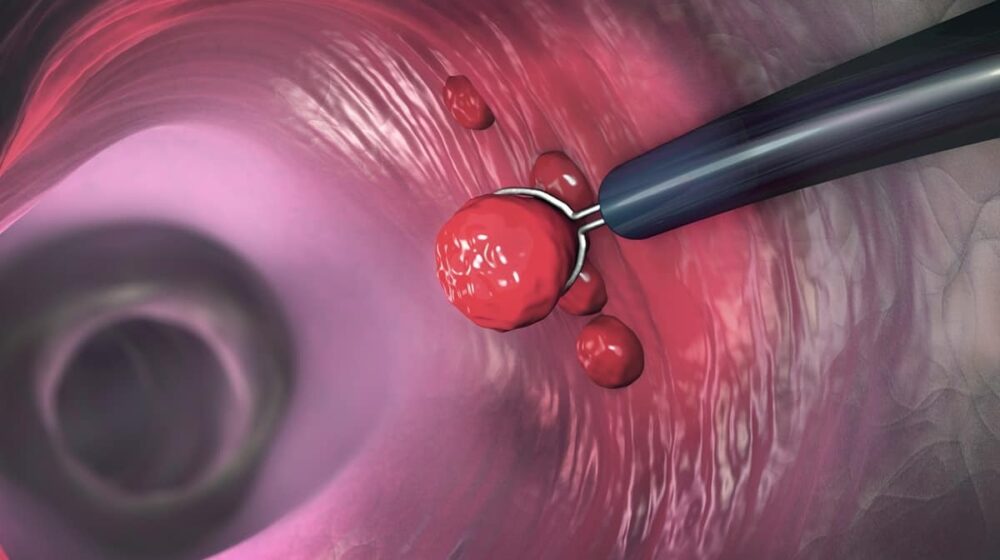 cảnh báo polyp gây ung thư y duoc thai nguyen