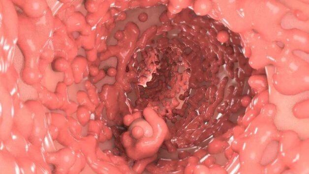 cảnh báo polyp gây ung thư y duoc thai nguyen