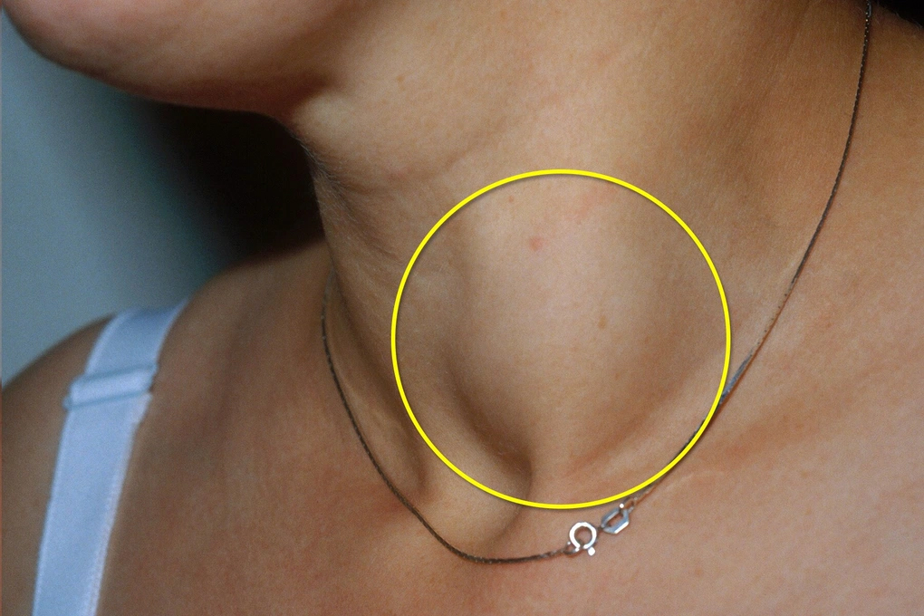 dấu hiệu ung thư tuyến giáp ở nữ y duoc thai nguyen