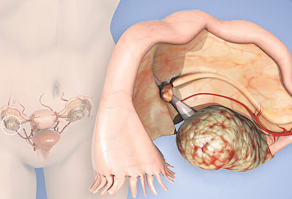 ung thư phụ khoa trẻ hóa y duoc thai nguyen