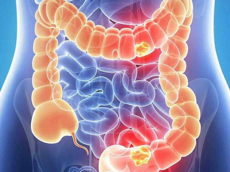 dấu hiệu đi đại tiện cảnh báo ung thư đại trực tràng y duoc thai nguyen